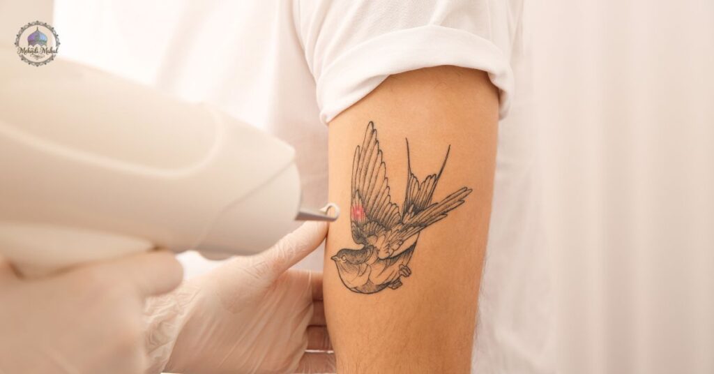 Pain Scale: Where Does Tattoo Removal Land?