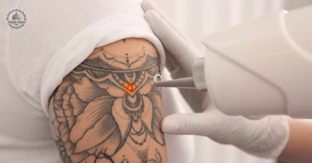 does tattoo removal hurt​