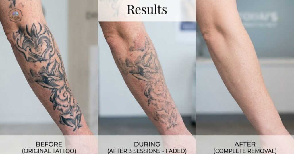 laser tattoo removal